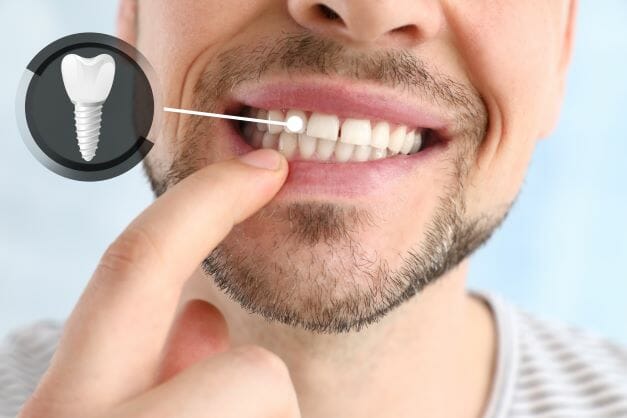 man pointing at his dental implant