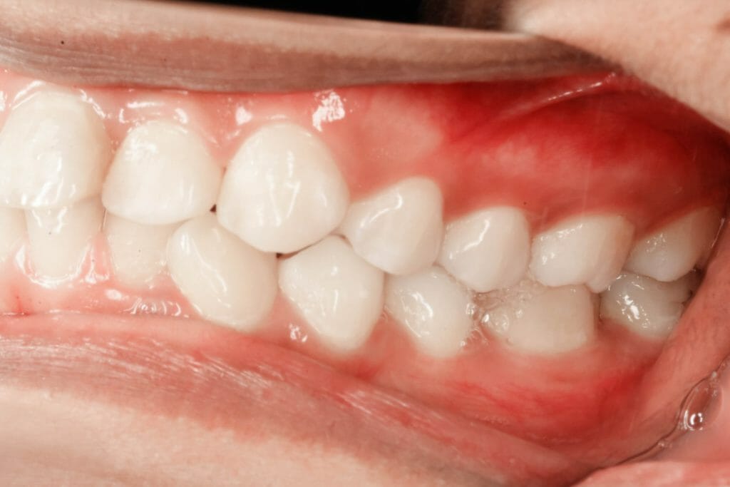 Signs and Symptoms of Gum Disease: What to Look For
