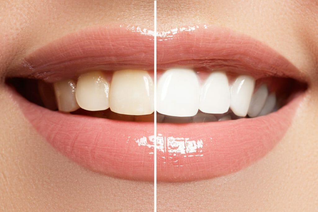 Teeth Whitening: What To Know